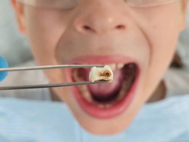 Best Emergency Broken Tooth Repair in Mountain Home, ID